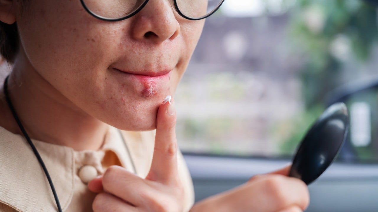 Herpes simplex virus is an infection that causes herpes.